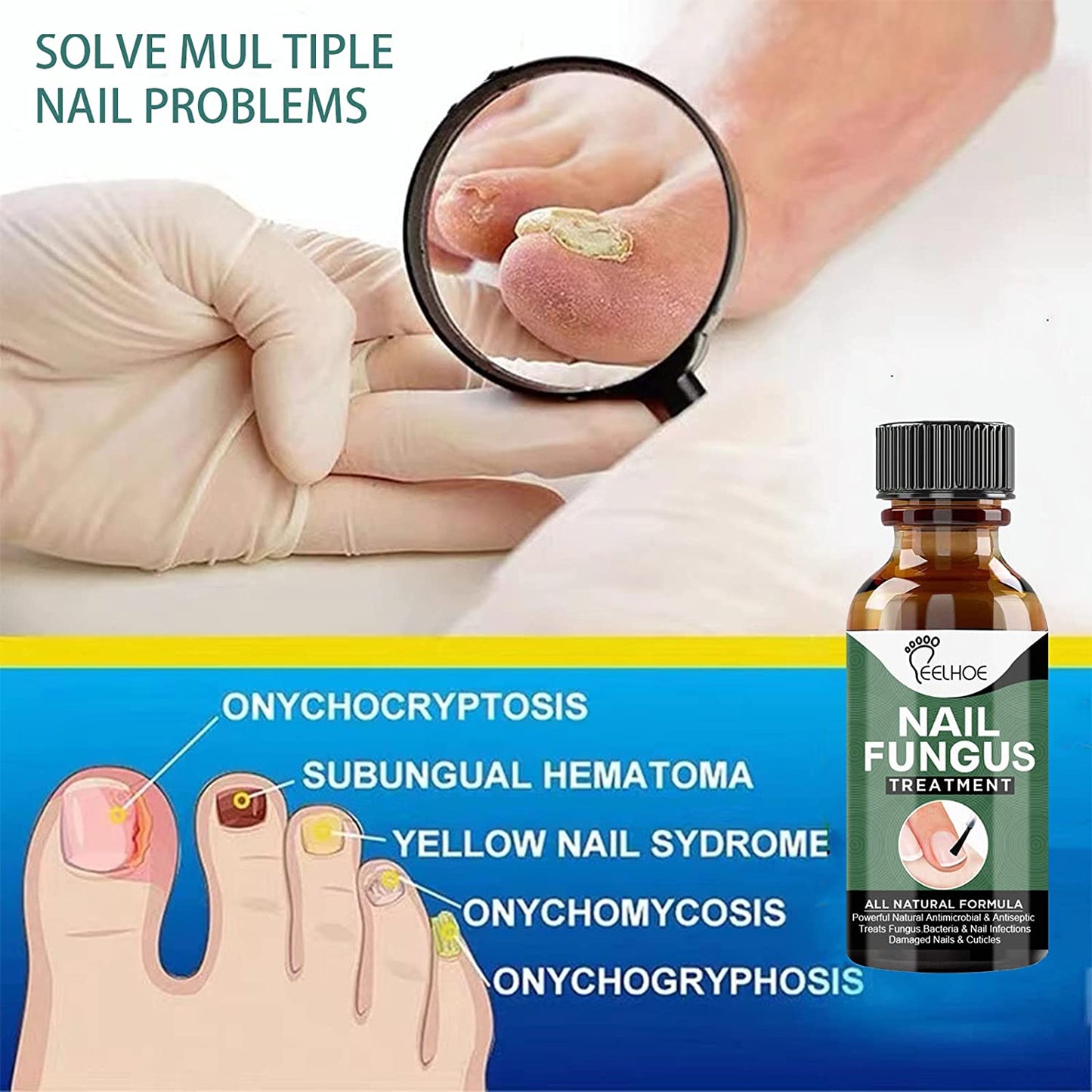 Fungal Nail Treatment,Antifungal Nail Repair,Antifungal Nail Treatment