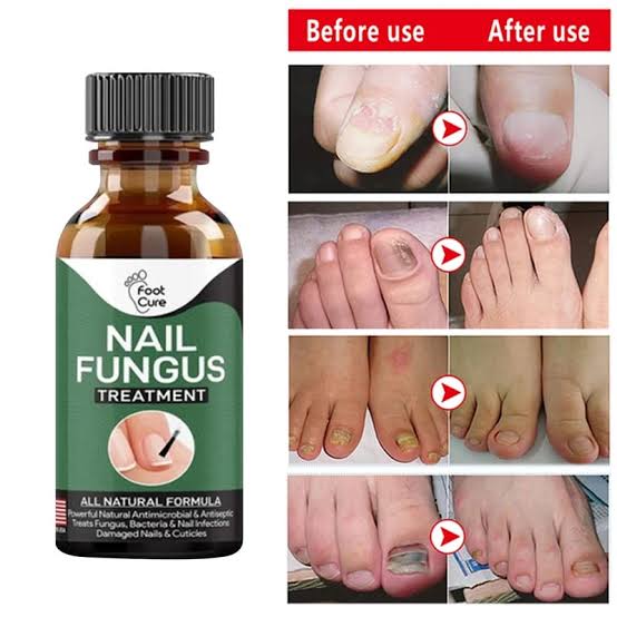 Fungal Nail Treatment,Antifungal Nail Repair,Antifungal Nail Treatment